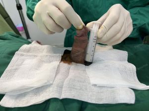 Độn dương vật bằng mô da nhân tạo, đường mổ ở mu, khách hàng 47 tuổi, Hà Nội - ca 134