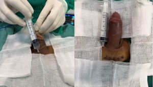 Độn dương vật bằng mô da nhân tạo megaderm, đường mổ ở mu, khách hàng 37 tuổi, Đà Nẵng - ca 138