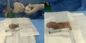 Độn dương vật bằng megaderm, đường mổ ở mu, khách hàng 31 tuổi, HCM - ca 140