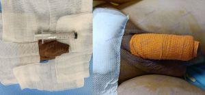 Tăng kích thước cậu nhỏ bằng tấm độn megaderm, đường mổ ở mu, khách hàng 40 tuổi, HCM - ca 141