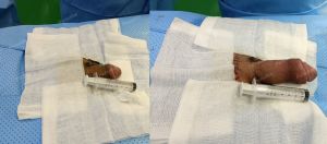 Độn dương vật bằng mô da nhân tạo, đường mổ ở mu, khách hàng 28 tuổi, Đồng Nai - ca 142