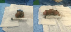 Tăng kích thước cậu nhỏ bằng tấm độn megaderm, đường mổ ở mu, khách hàng 30 tuổi, Long An - ca 147