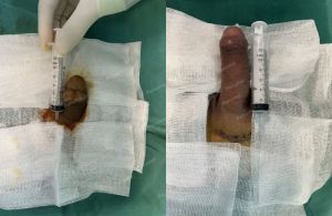 Độn dương vật bằng mô da nhân tạo, đường mổ ở mu, khách hàng 38 tuổi, Hải Phòng - ca 150