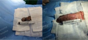 Tăng kích thước dương vật bằng megaderm, đường mổ ở mu, khách hàng 47 tuổi, HCM - ca 143