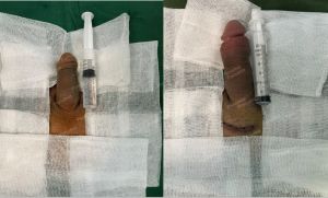 Độn dương vật bằng mô da nhân tạo, đường mổ ở mu, khách hàng 30 tuổi, Hà Nội - ca 144