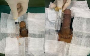 Độn dương vật bằng tấm độn megaderm, đường mổ ở mu, khách hàng 40 tuổi, Lạng Sơn - ca 156