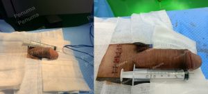 Độn dương vật bằng tấm độn sinh học, đường mổ ở mu, khách hàng 41 tuổi, HCM - ca 157