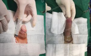 Tăng kích thước cậu nhỏ bằng tấm độn sinh học megaderm, đường mổ ở mu, khách hàng 41 tuổi, Hà Nội - ca 145