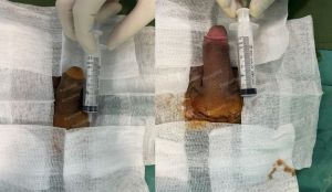 Tăng kích thước cậu bé bằng tấm độn megaderm, đường mổ ở mu, khách hàng 39 tuổi, Hà Nội - ca 151