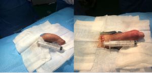 Độn dương vật bằng mô da nhân tạo, đường mổ ở mu, khách hàng 30 tuổi, HCM - ca 152