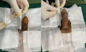 Tăng kích thước cậu nhỏ bằng tấm độn sinh học megaderm, đường mổ ở mu, khách hàng 31 tuổi, Hà Nội - ca 153