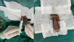 Độn dương vật bằng mô da nhân tạo, đường mổ ở mu, khách hàng 43 tuổi, Ninh Bình - ca 154