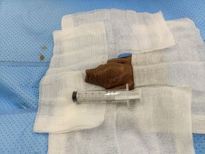 Tăng kích thước cậu nhỏ bằng tấm độn megaderm, đường mổ ở mu, khách hàng 40 tuổi, HCM - ca 141