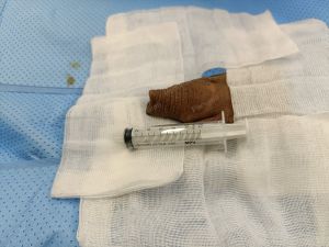 Tăng kích thước cậu nhỏ bằng tấm độn megaderm, đường mổ ở mu, khách hàng 40 tuổi, HCM - ca 141