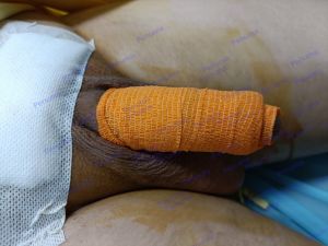 Tăng kích thước cậu nhỏ bằng tấm độn megaderm, đường mổ ở mu, khách hàng 40 tuổi, HCM - ca 141