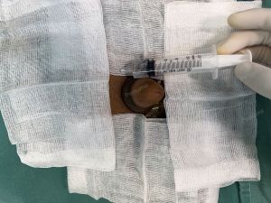 Độn dương vật bằng mô da nhân tạo megaderm, đường mổ ở mu, khách hàng 37 tuổi, Đà Nẵng - ca 138