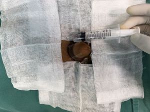 Độn dương vật bằng mô da nhân tạo megaderm, đường mổ ở mu, khách hàng 37 tuổi, Đà Nẵng - ca 138