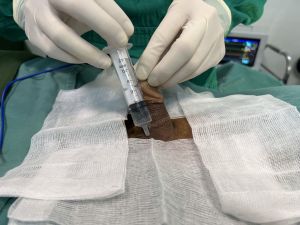 Độn dương vật bằng mô da nhân tạo megaderm, đường mổ ở mu, khách hàng 37 tuổi, Đà Nẵng - ca 138