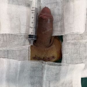 Độn dương vật bằng mô da nhân tạo megaderm, đường mổ ở mu, khách hàng 37 tuổi, Đà Nẵng - ca 138