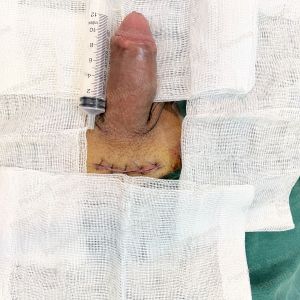 Độn dương vật bằng mô da nhân tạo megaderm, đường mổ ở mu, khách hàng 37 tuổi, Đà Nẵng - ca 138