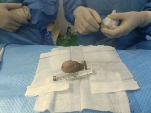 Độn dương vật bằng megaderm, đường mổ ở mu, khách hàng 31 tuổi, HCM - ca 140