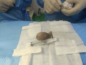 Độn dương vật bằng megaderm, đường mổ ở mu, khách hàng 31 tuổi, HCM - ca 140