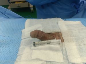 Độn dương vật bằng megaderm, đường mổ ở mu, khách hàng 31 tuổi, HCM - ca 140