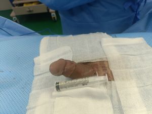 Độn dương vật bằng megaderm, đường mổ ở mu, khách hàng 31 tuổi, HCM - ca 140