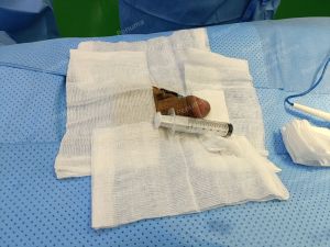 Độn dương vật bằng mô da nhân tạo, đường mổ ở mu, khách hàng 28 tuổi, Đồng Nai - ca 142