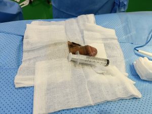 Độn dương vật bằng mô da nhân tạo, đường mổ ở mu, khách hàng 28 tuổi, Đồng Nai - ca 142