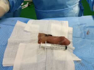 Độn dương vật bằng mô da nhân tạo, đường mổ ở mu, khách hàng 28 tuổi, Đồng Nai - ca 142