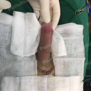 Tăng kích thước cậu nhỏ bằng tấm độn sinh học megaderm, đường mổ ở mu, khách hàng 41 tuổi, Hà Nội - ca 145