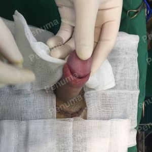 Tăng kích thước cậu nhỏ bằng tấm độn sinh học megaderm, đường mổ ở mu, khách hàng 41 tuổi, Hà Nội - ca 145