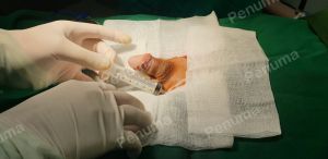 Tăng kích thước cậu nhỏ bằng tấm độn sinh học megaderm, đường mổ ở mu, khách hàng 41 tuổi, Hà Nội - ca 145