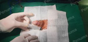 Tăng kích thước cậu nhỏ bằng tấm độn sinh học megaderm, đường mổ ở mu, khách hàng 41 tuổi, Hà Nội - ca 145