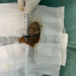 Độn dương vật bằng mô da nhân tạo, đường mổ ở mu, khách hàng 38 tuổi, Hải Phòng - ca 150