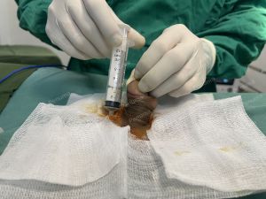 Độn dương vật bằng mô da nhân tạo, đường mổ ở mu, khách hàng 38 tuổi, Hải Phòng - ca 150