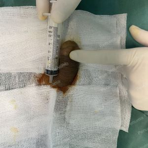 Độn dương vật bằng mô da nhân tạo, đường mổ ở mu, khách hàng 38 tuổi, Hải Phòng - ca 150