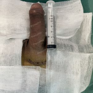 Độn dương vật bằng mô da nhân tạo, đường mổ ở mu, khách hàng 38 tuổi, Hải Phòng - ca 150