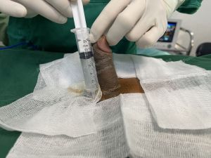 Độn dương vật bằng mô da nhân tạo, đường mổ ở mu, khách hàng 30 tuổi, Hà Nội - ca 144