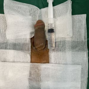 Độn dương vật bằng mô da nhân tạo, đường mổ ở mu, khách hàng 30 tuổi, Hà Nội - ca 144