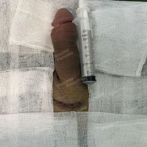 Độn dương vật bằng mô da nhân tạo, đường mổ ở mu, khách hàng 30 tuổi, Hà Nội - ca 144