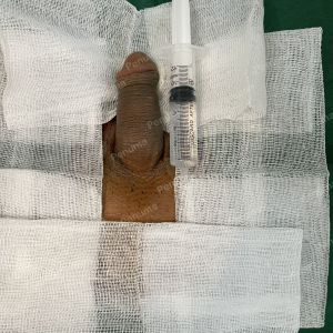 Độn dương vật bằng mô da nhân tạo, đường mổ ở mu, khách hàng 30 tuổi, Hà Nội - ca 144