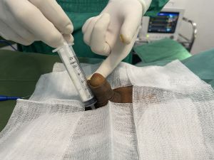 Tăng kích thước cậu bé bằng tấm độn megaderm, đường mổ ở mu, khách hàng 39 tuổi, Hà Nội - ca 151