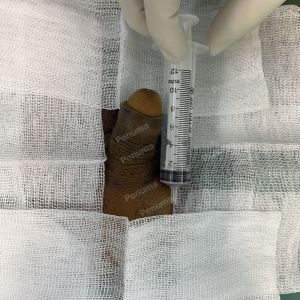 Tăng kích thước cậu bé bằng tấm độn megaderm, đường mổ ở mu, khách hàng 39 tuổi, Hà Nội - ca 151