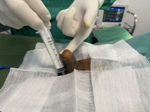 Tăng kích thước cậu bé bằng tấm độn megaderm, đường mổ ở mu, khách hàng 39 tuổi, Hà Nội - ca 151