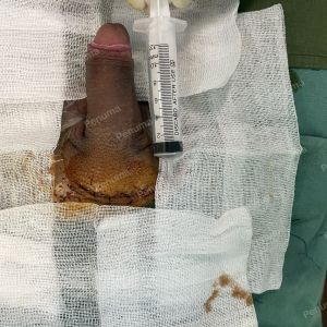 Tăng kích thước cậu bé bằng tấm độn megaderm, đường mổ ở mu, khách hàng 39 tuổi, Hà Nội - ca 151