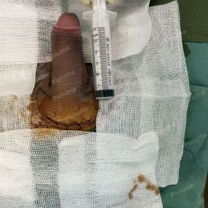 Tăng kích thước cậu bé bằng tấm độn megaderm, đường mổ ở mu, khách hàng 39 tuổi, Hà Nội - ca 151