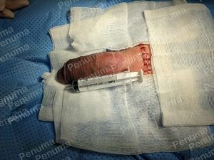 Tăng kích thước dương vật bằng megaderm, đường mổ ở mu, khách hàng 47 tuổi, HCM - ca 143