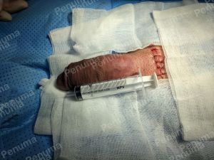 Tăng kích thước dương vật bằng megaderm, đường mổ ở mu, khách hàng 47 tuổi, HCM - ca 143